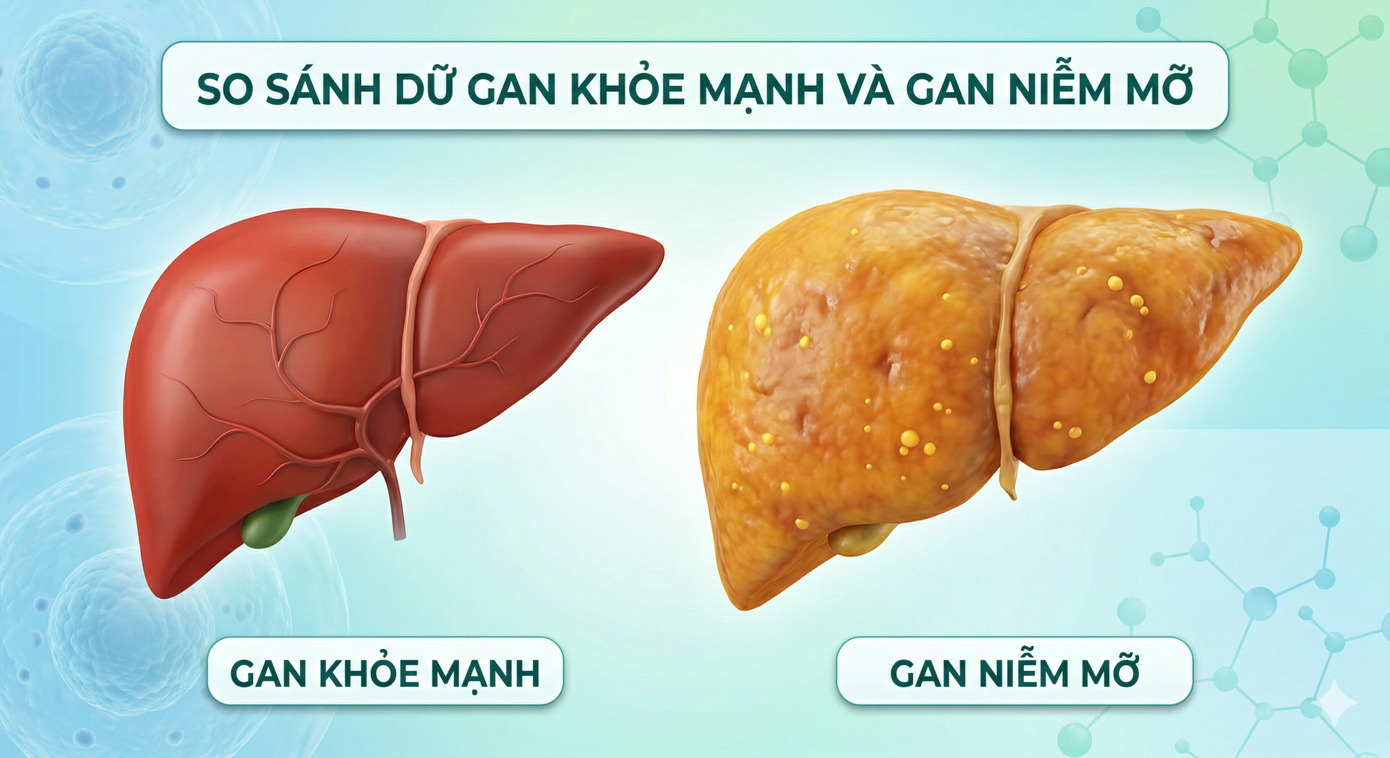 Gan Nhiễm Mỡ Là Gì? Nguyên Nhân, Dấu Hiệu Và Cách Cải Thiện Hiệu Quả